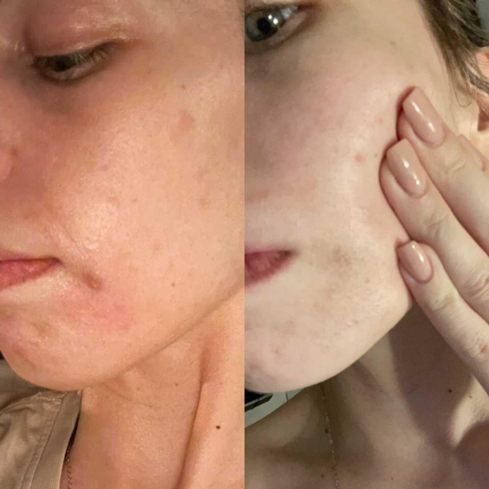 Before and After, results in one week. Brightening serum for sensitive skin, fights pigmentation, antibacterial, fights acne, stops breakouts. soothes, brightens and softens skin, Infused with natural ingredients. Skincare for sensitive skin. Anti-ageing, fine lines, Natural, vegan and cruelty-free skincare. Breastfeeding friendly, pregnancy safe. serum for sensitive skin, water based serum. All natural