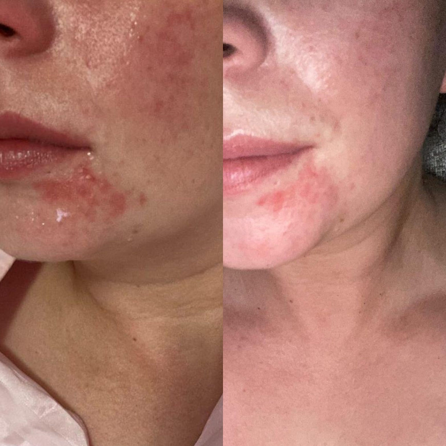 Before and after photos, results in 4 days, social proof.Nourishing face oil serum for sensitive skin, preservative free, soothes, brightens and softens skin, Infused with natural ingredients. Skincare for sensitive skin. Anti-ageing, fine lines, Natural, vegan and cruelty-free skincare. Breastfeeding friendly, pregnancy safe. Facial oil for sensitive skin, Oil serum. All natural. 